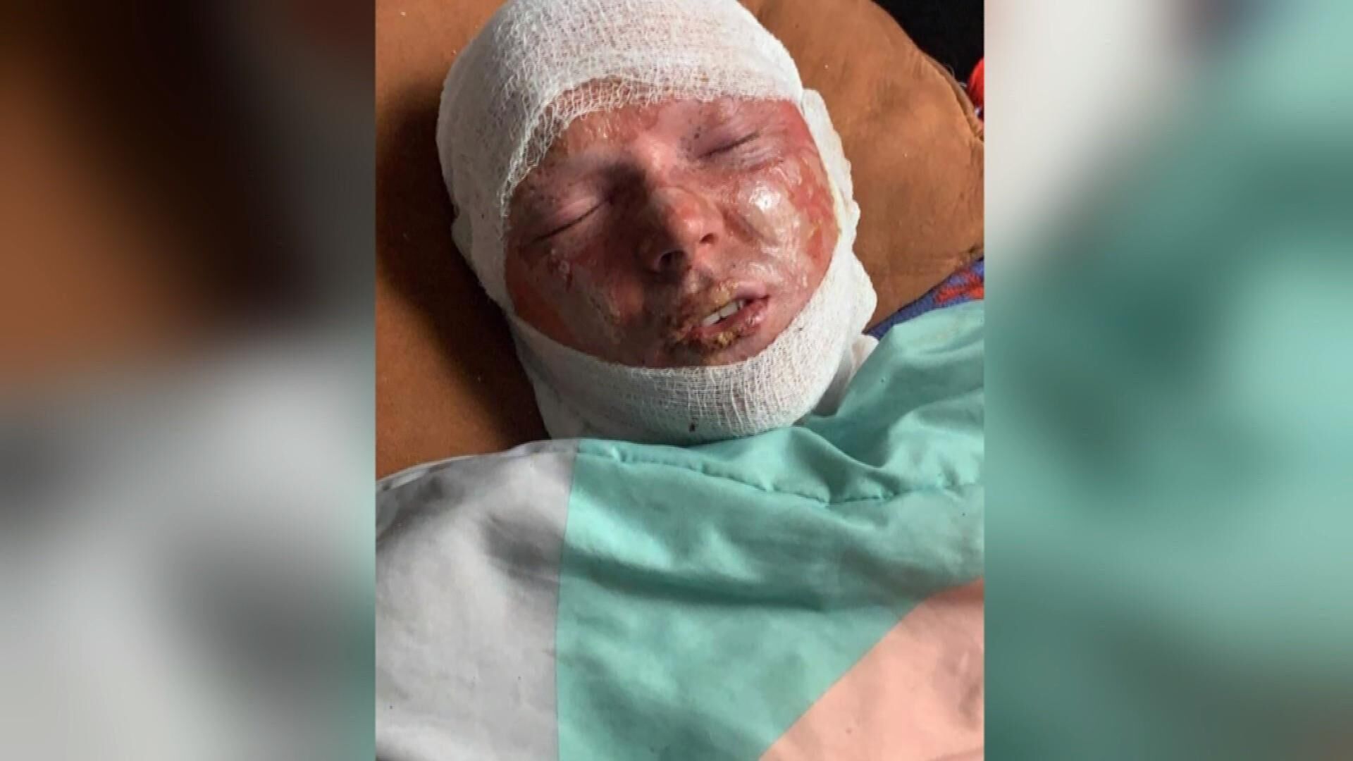 Baraboo firefighter badly burned in freak accident